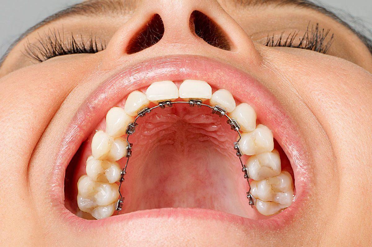 Lingual braces are also called invisible braces